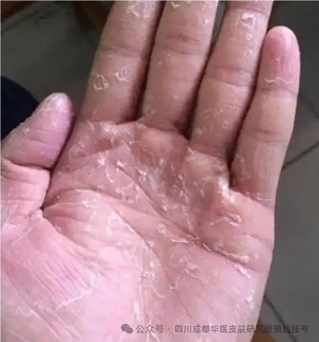 为什么手足癣会反反复复的发作，手足癣反复发作，应该怎么治疗？