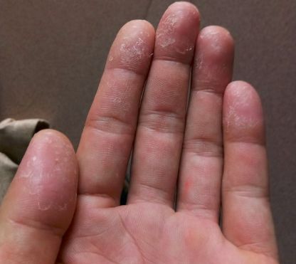 手足癣经常使用洗洁精竟会招来这种难缠的皮肤问题！起皮、瘙痒、还会传染！