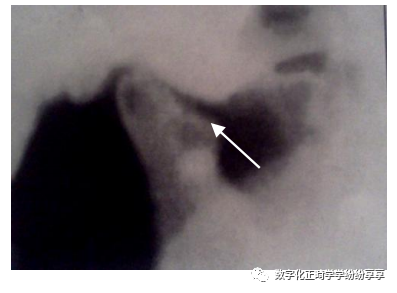 曲面断层片怎么看正畸【曲面断层片（全景片）】如何解读和查看：牙周？牙体？牙髓？关节？_https://www.jmylbn.com_新闻资讯_第27张