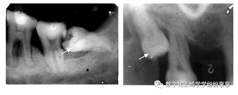 曲面断层片怎么看正畸【曲面断层片（全景片）】如何解读和查看：牙周？牙体？牙髓？关节？_https://www.jmylbn.com_新闻资讯_第19张