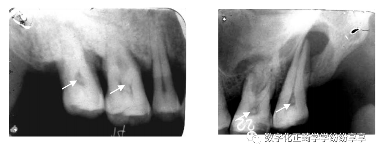曲面断层片怎么看正畸【曲面断层片（全景片）】如何解读和查看：牙周？牙体？牙髓？关节？_https://www.jmylbn.com_新闻资讯_第5张
