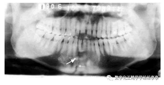 曲面断层片怎么看正畸【曲面断层片（全景片）】如何解读和查看：牙周？牙体？牙髓？关节？_https://www.jmylbn.com_新闻资讯_第24张