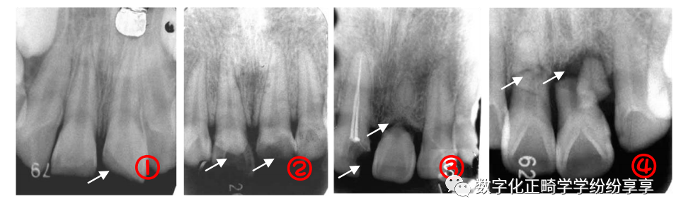 曲面断层片怎么看正畸【曲面断层片（全景片）】如何解读和查看：牙周？牙体？牙髓？关节？_https://www.jmylbn.com_新闻资讯_第20张