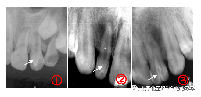 曲面断层片怎么看正畸【曲面断层片（全景片）】如何解读和查看：牙周？牙体？牙髓？关节？_https://www.jmylbn.com_新闻资讯_第17张