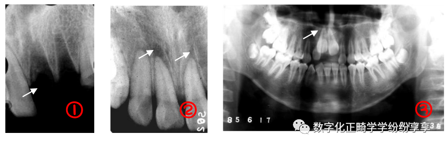 曲面断层片怎么看正畸【曲面断层片（全景片）】如何解读和查看：牙周？牙体？牙髓？关节？_https://www.jmylbn.com_新闻资讯_第22张