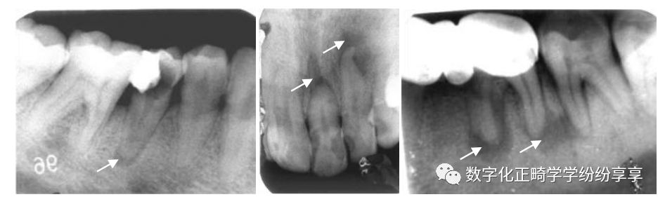 曲面断层片怎么看正畸【曲面断层片（全景片）】如何解读和查看：牙周？牙体？牙髓？关节？_https://www.jmylbn.com_新闻资讯_第7张