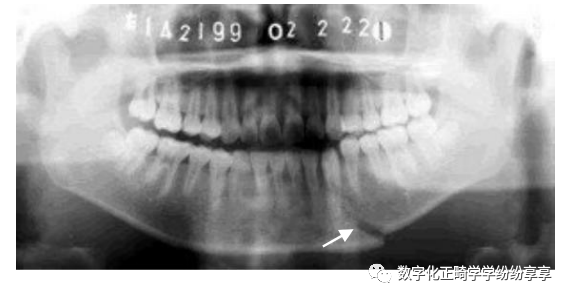 曲面断层片怎么看正畸【曲面断层片（全景片）】如何解读和查看：牙周？牙体？牙髓？关节？_https://www.jmylbn.com_新闻资讯_第25张