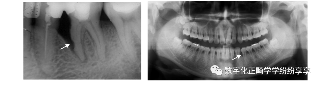 曲面断层片怎么看正畸【曲面断层片（全景片）】如何解读和查看：牙周？牙体？牙髓？关节？_https://www.jmylbn.com_新闻资讯_第14张
