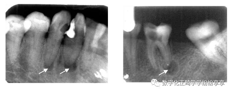 曲面断层片怎么看正畸【曲面断层片（全景片）】如何解读和查看：牙周？牙体？牙髓？关节？_https://www.jmylbn.com_新闻资讯_第8张