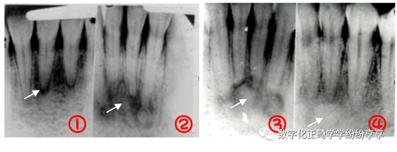 曲面断层片怎么看正畸【曲面断层片（全景片）】如何解读和查看：牙周？牙体？牙髓？关节？_https://www.jmylbn.com_新闻资讯_第12张