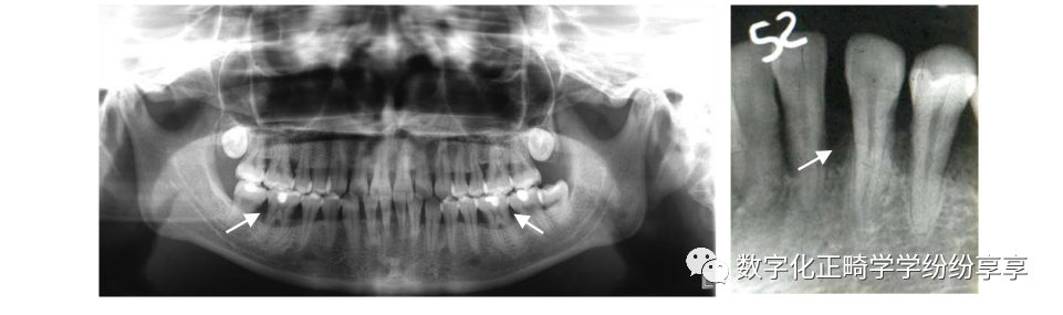曲面断层片怎么看正畸【曲面断层片（全景片）】如何解读和查看：牙周？牙体？牙髓？关节？_https://www.jmylbn.com_新闻资讯_第13张