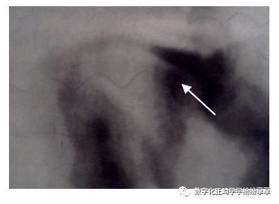 曲面断层片怎么看正畸【曲面断层片（全景片）】如何解读和查看：牙周？牙体？牙髓？关节？_https://www.jmylbn.com_新闻资讯_第29张