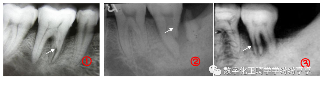 曲面断层片怎么看正畸【曲面断层片（全景片）】如何解读和查看：牙周？牙体？牙髓？关节？_https://www.jmylbn.com_新闻资讯_第21张