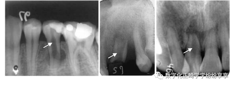 曲面断层片怎么看正畸【曲面断层片（全景片）】如何解读和查看：牙周？牙体？牙髓？关节？_https://www.jmylbn.com_新闻资讯_第4张