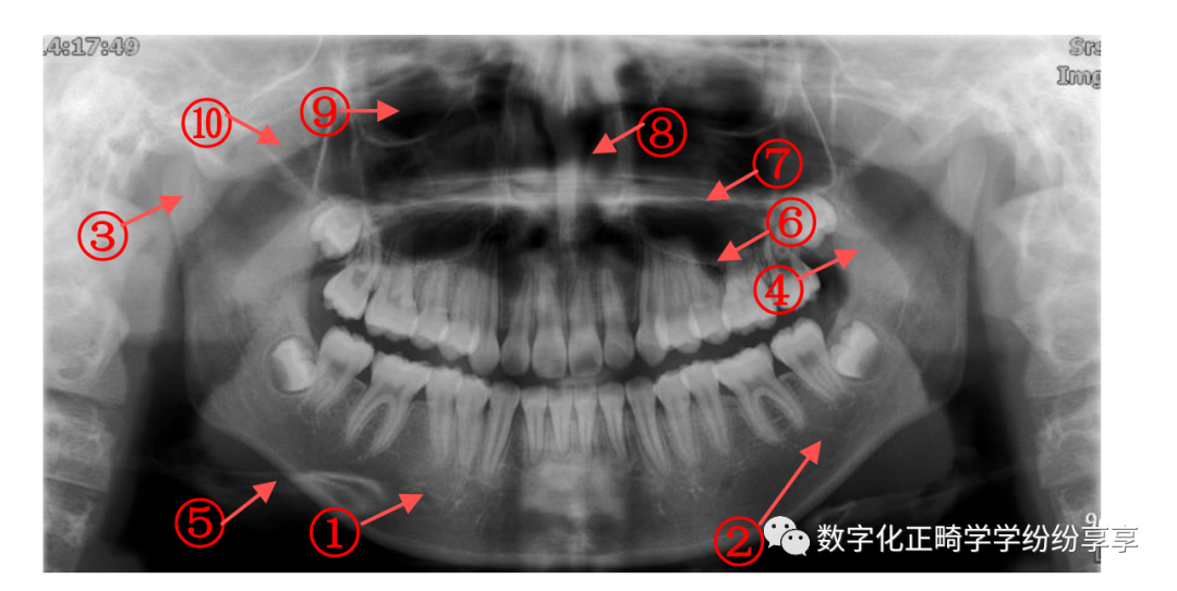曲面断层片怎么看正畸【曲面断层片（全景片）】如何解读和查看：牙周？牙体？牙髓？关节？_https://www.jmylbn.com_新闻资讯_第1张