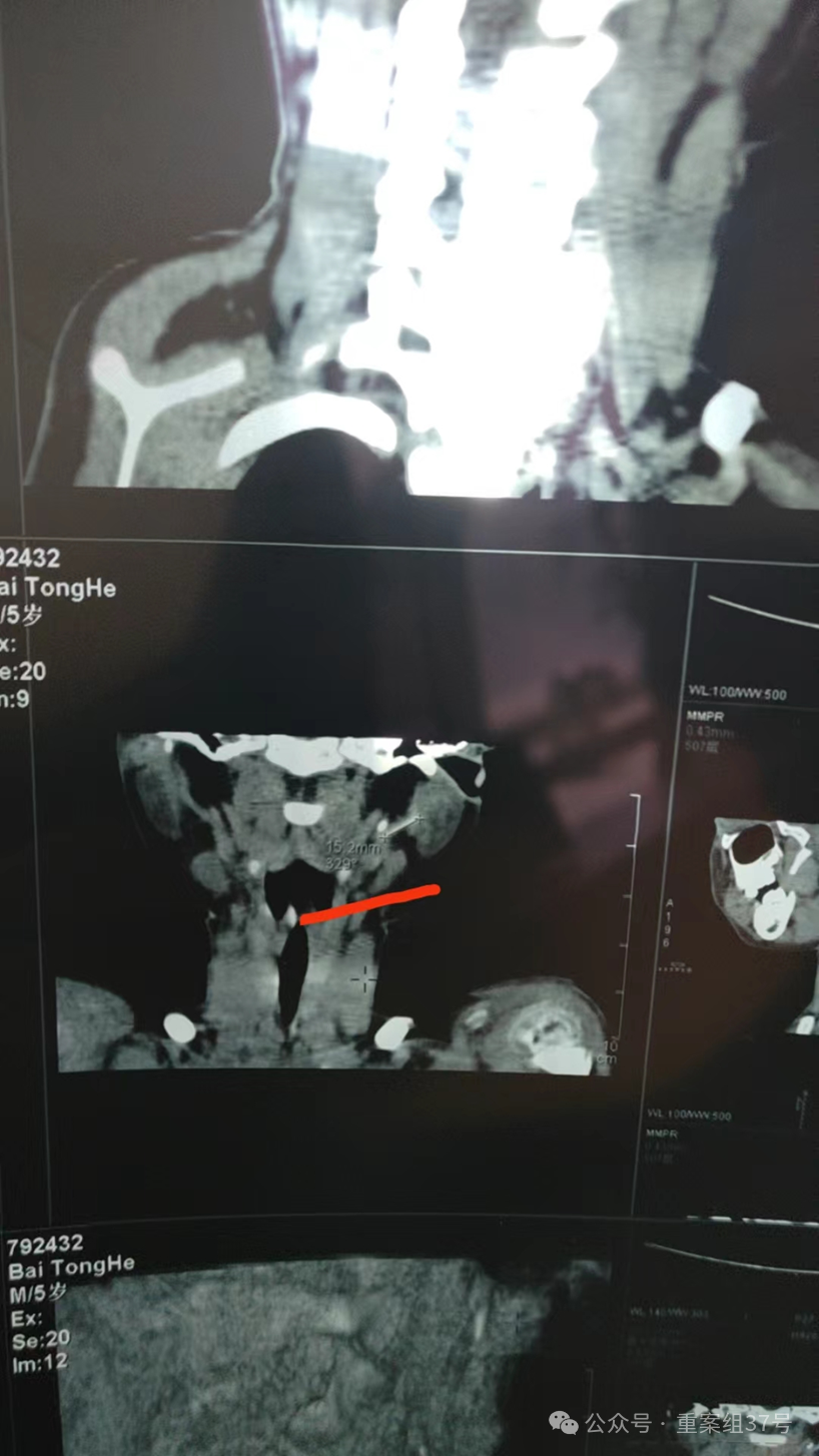 留置针怎么取出长达5年！男孩体内遗留留置针软管，如今…_https://www.jmylbn.com_新闻资讯_第4张