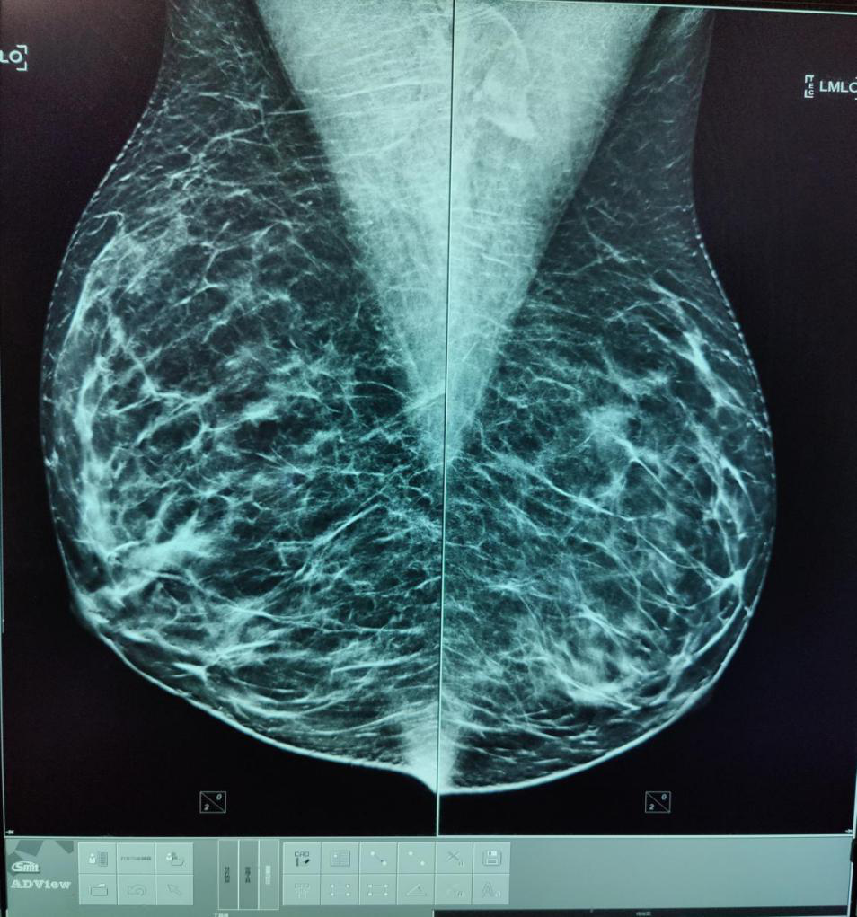 数字化乳腺摄影是什么让乳腺微小病灶无处遁形 ｜ 豪洛捷智能3D数字乳腺摄影系统_https://www.jmylbn.com_新闻资讯_第14张