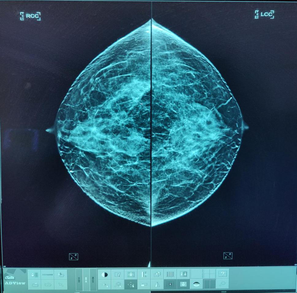 数字化乳腺摄影是什么让乳腺微小病灶无处遁形 ｜ 豪洛捷智能3D数字乳腺摄影系统_https://www.jmylbn.com_新闻资讯_第12张