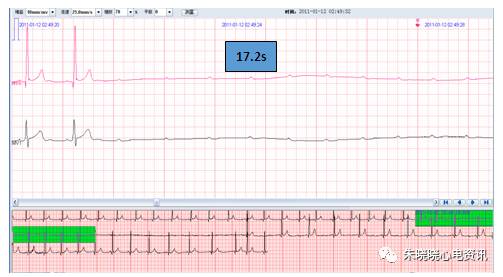 什么是远程监护石亚君主任心电系列之二：远程心电监护的临床应用_https://www.jmylbn.com_新闻资讯_第12张