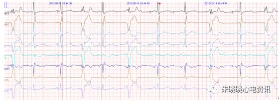 什么是远程监护石亚君主任心电系列之二：远程心电监护的临床应用_https://www.jmylbn.com_新闻资讯_第15张