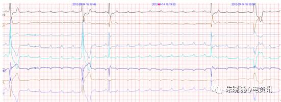 什么是远程监护石亚君主任心电系列之二：远程心电监护的临床应用_https://www.jmylbn.com_新闻资讯_第14张