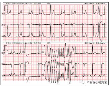 什么是远程监护石亚君主任心电系列之二：远程心电监护的临床应用_https://www.jmylbn.com_新闻资讯_第19张