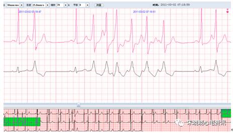 什么是远程监护石亚君主任心电系列之二：远程心电监护的临床应用_https://www.jmylbn.com_新闻资讯_第16张