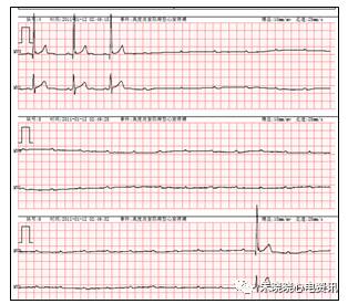什么是远程监护石亚君主任心电系列之二：远程心电监护的临床应用_https://www.jmylbn.com_新闻资讯_第11张