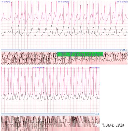 什么是远程监护石亚君主任心电系列之二：远程心电监护的临床应用_https://www.jmylbn.com_新闻资讯_第17张