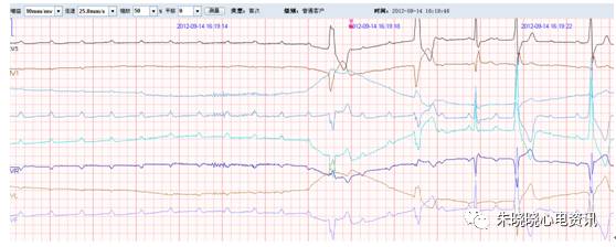 什么是远程监护石亚君主任心电系列之二：远程心电监护的临床应用_https://www.jmylbn.com_新闻资讯_第13张
