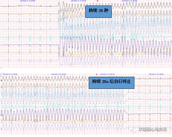 什么是远程监护石亚君主任心电系列之二：远程心电监护的临床应用_https://www.jmylbn.com_新闻资讯_第18张