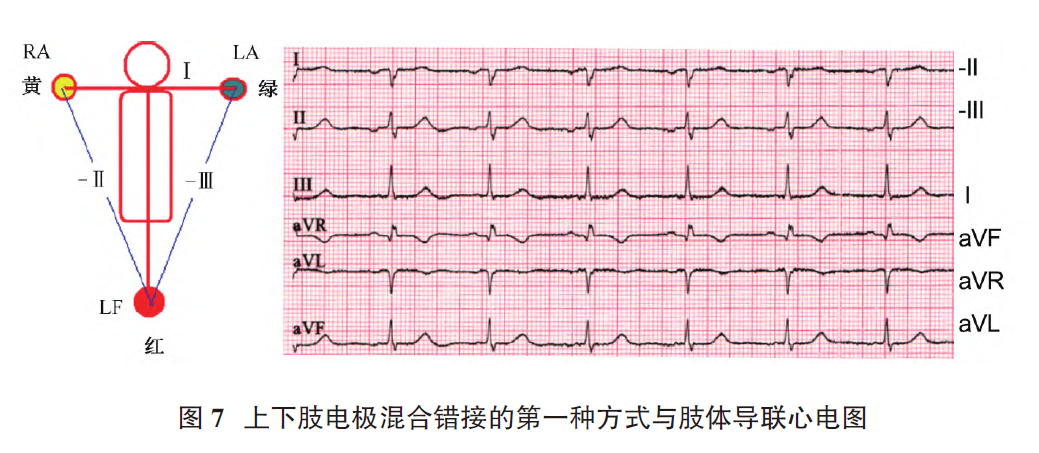 心电图电机脱落怎么回事肢体导联电极错接致“蹊跷心电图”_https://www.jmylbn.com_新闻资讯_第9张