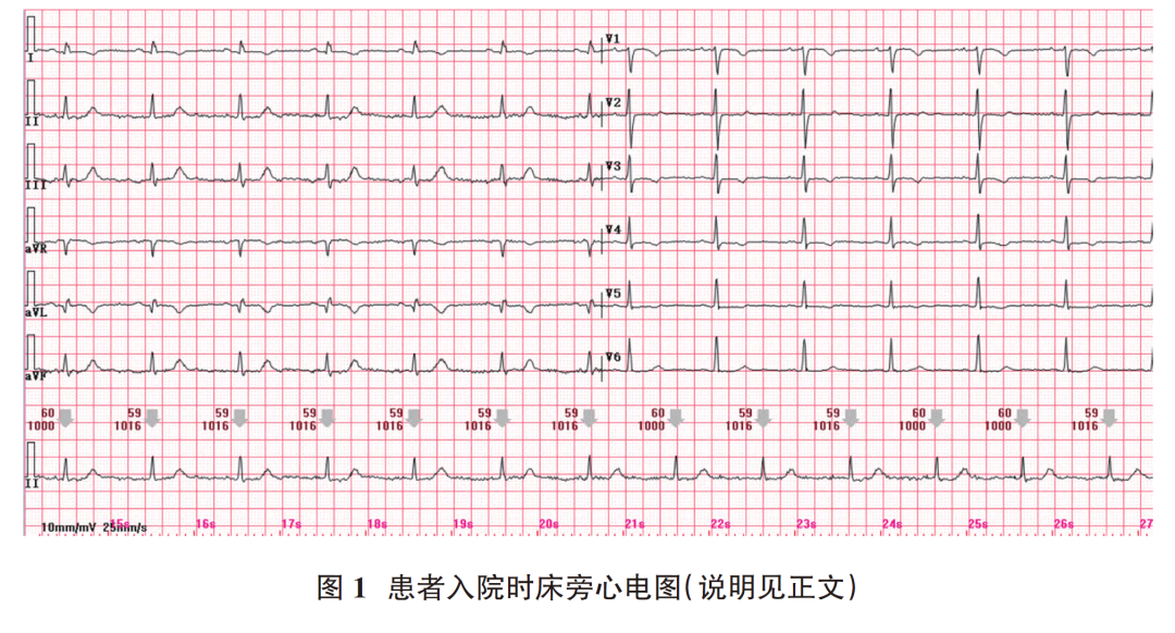 心电图电机脱落怎么回事肢体导联电极错接致“蹊跷心电图”_https://www.jmylbn.com_新闻资讯_第3张
