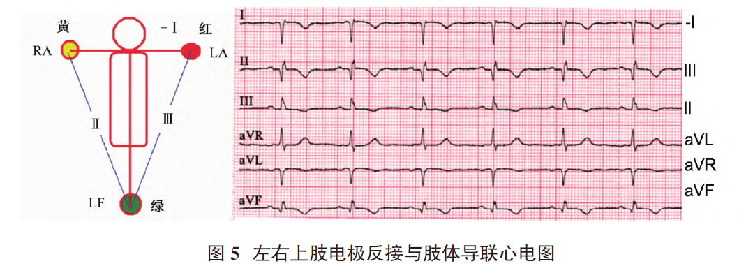 心电图电机脱落怎么回事肢体导联电极错接致“蹊跷心电图”_https://www.jmylbn.com_新闻资讯_第7张