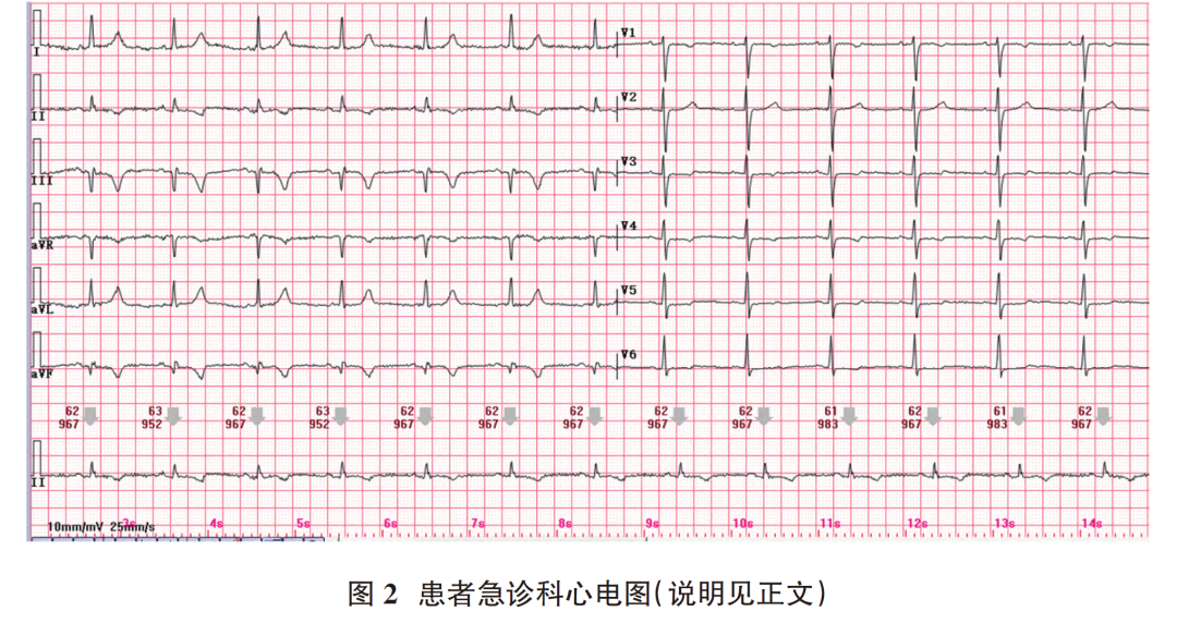 心电图电机脱落怎么回事肢体导联电极错接致“蹊跷心电图”_https://www.jmylbn.com_新闻资讯_第4张