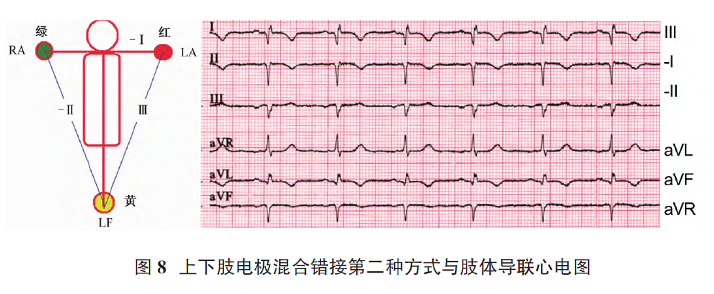 心电图电机脱落怎么回事肢体导联电极错接致“蹊跷心电图”_https://www.jmylbn.com_新闻资讯_第10张