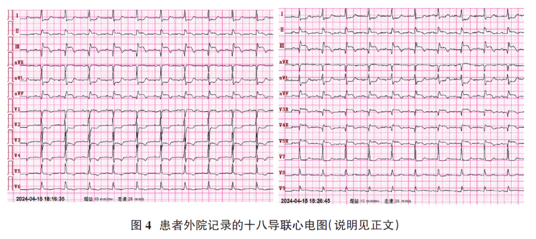 心电图电机脱落怎么回事肢体导联电极错接致“蹊跷心电图”_https://www.jmylbn.com_新闻资讯_第6张