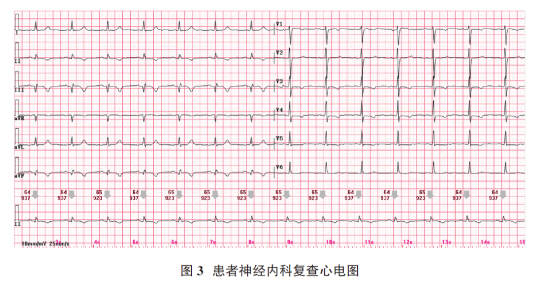 心电图电机脱落怎么回事肢体导联电极错接致“蹊跷心电图”_https://www.jmylbn.com_新闻资讯_第5张