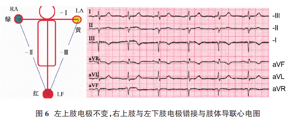 心电图电机脱落怎么回事肢体导联电极错接致“蹊跷心电图”_https://www.jmylbn.com_新闻资讯_第8张