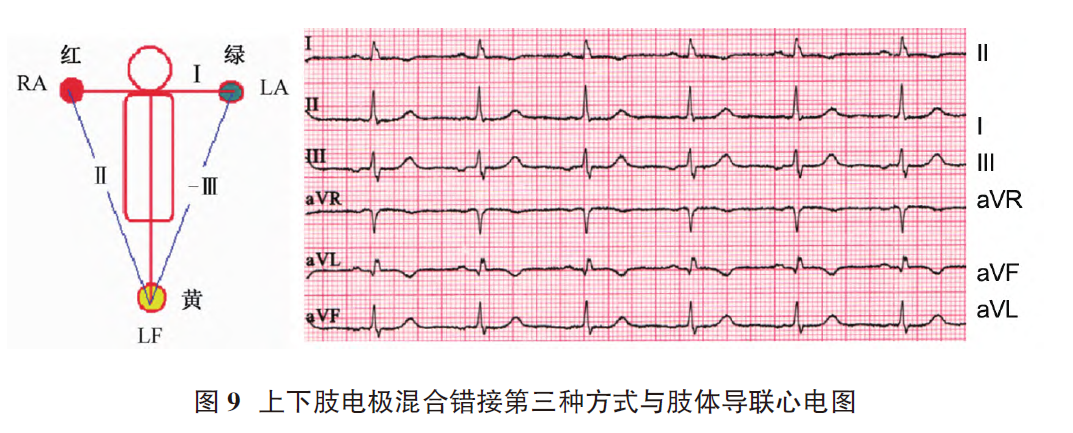 心电图电机脱落怎么回事肢体导联电极错接致“蹊跷心电图”_https://www.jmylbn.com_新闻资讯_第11张