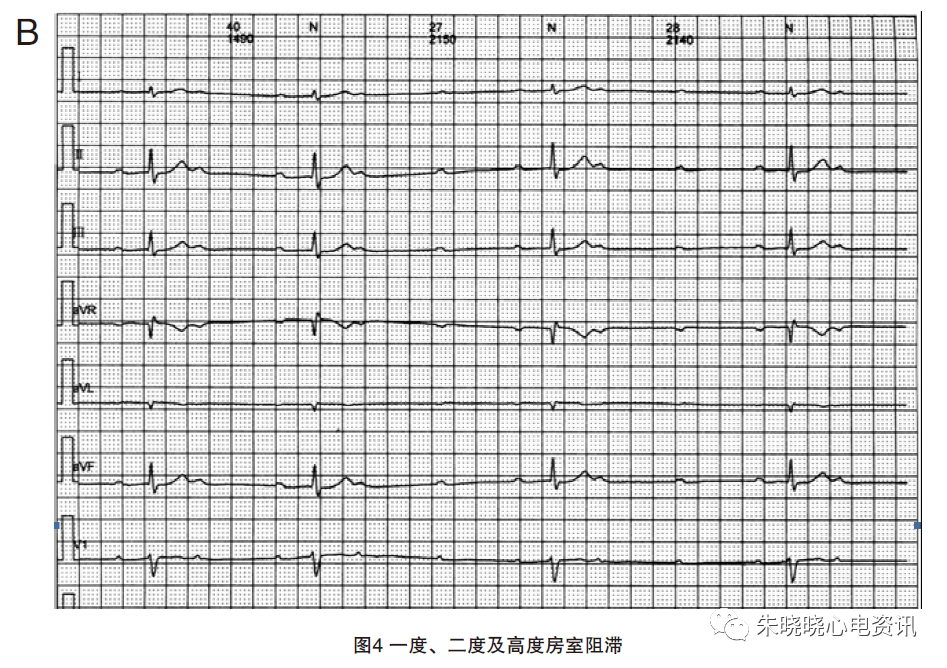 动态心电图怎么分析动态心电图，如何分析和诊断_https://www.jmylbn.com_新闻资讯_第6张