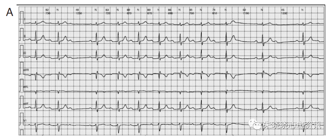 动态心电图怎么分析动态心电图，如何分析和诊断_https://www.jmylbn.com_新闻资讯_第5张