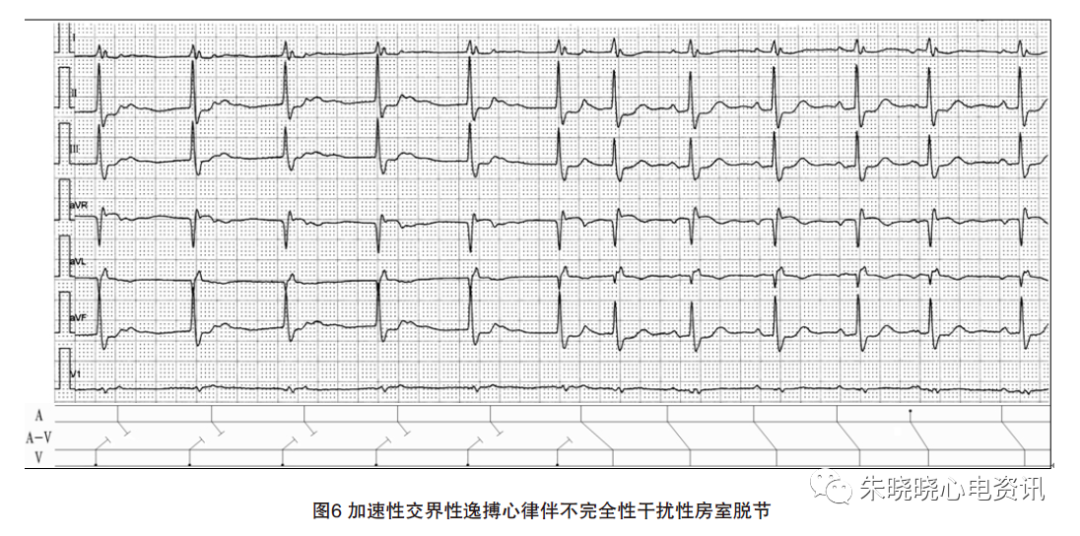 动态心电图怎么分析动态心电图，如何分析和诊断_https://www.jmylbn.com_新闻资讯_第8张