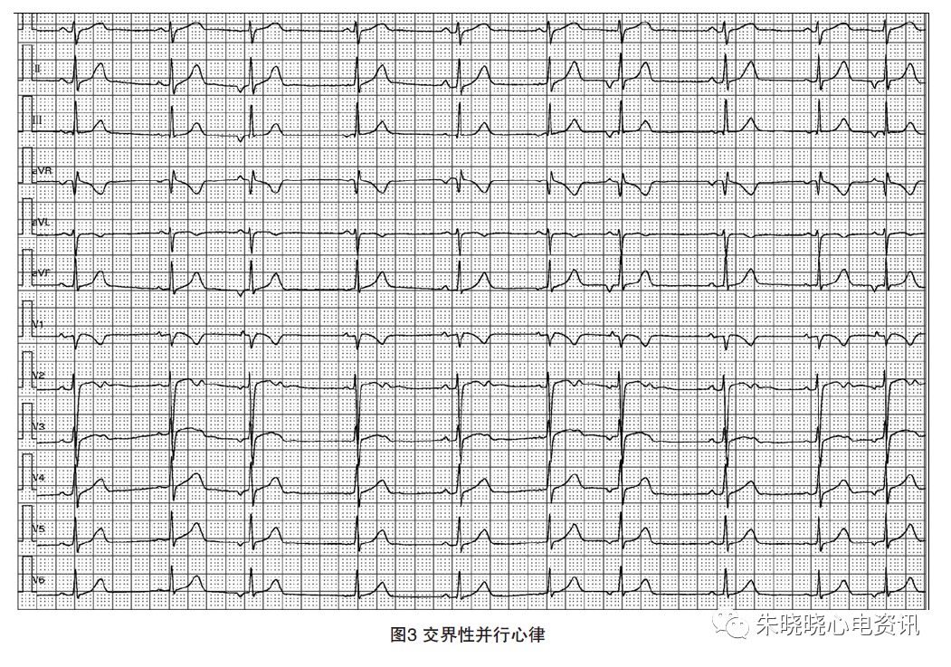 动态心电图怎么分析动态心电图，如何分析和诊断_https://www.jmylbn.com_新闻资讯_第4张