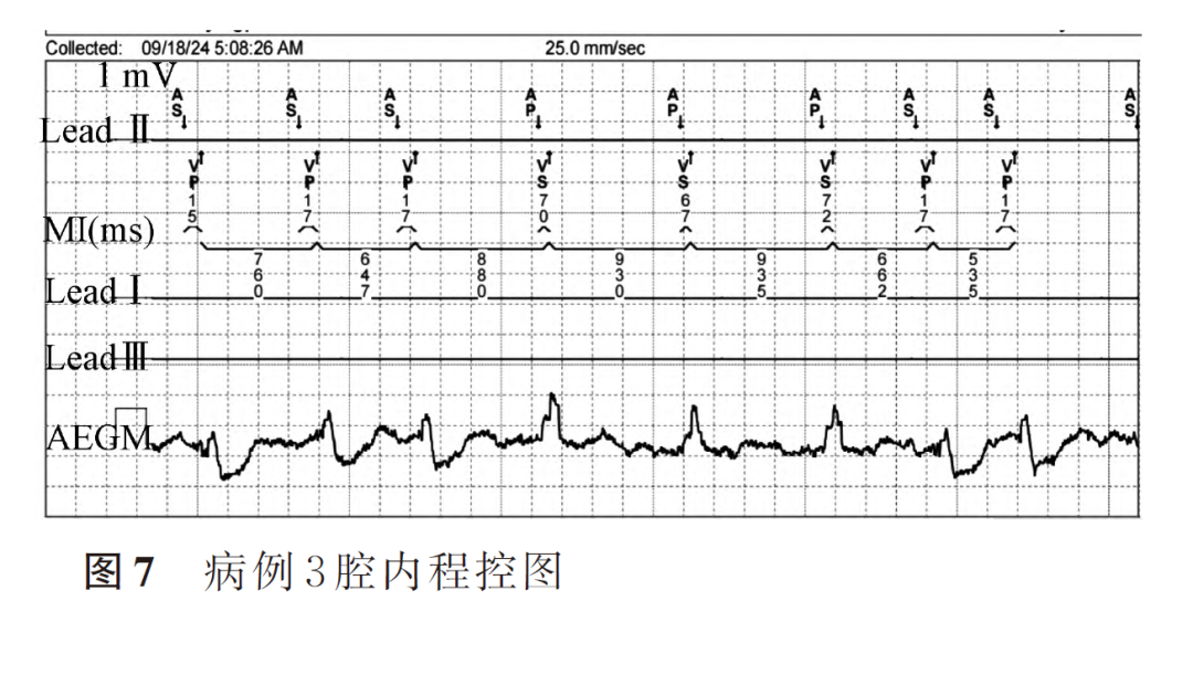 百多力起搏器怎么样两种心室起搏图形的3 种情况_https://www.jmylbn.com_新闻资讯_第9张