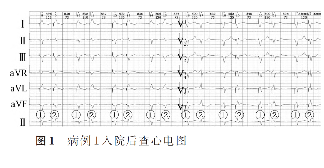 百多力起搏器怎么样两种心室起搏图形的3 种情况_https://www.jmylbn.com_新闻资讯_第3张
