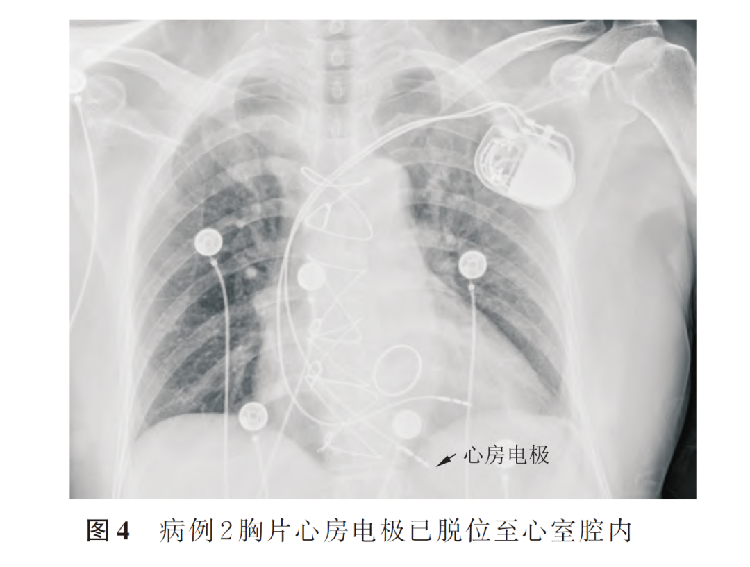 百多力起搏器怎么样两种心室起搏图形的3 种情况_https://www.jmylbn.com_新闻资讯_第6张