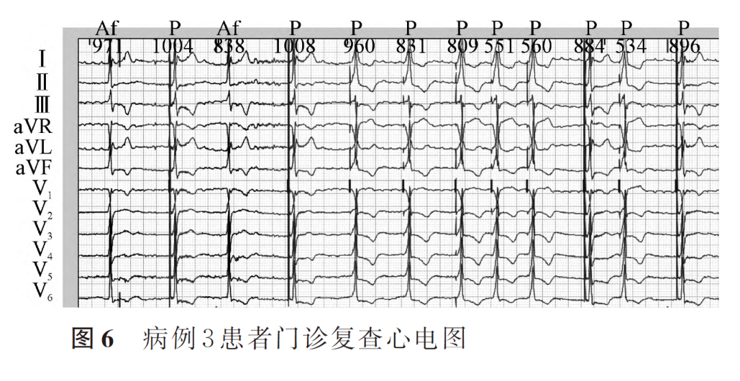 百多力起搏器怎么样两种心室起搏图形的3 种情况_https://www.jmylbn.com_新闻资讯_第8张