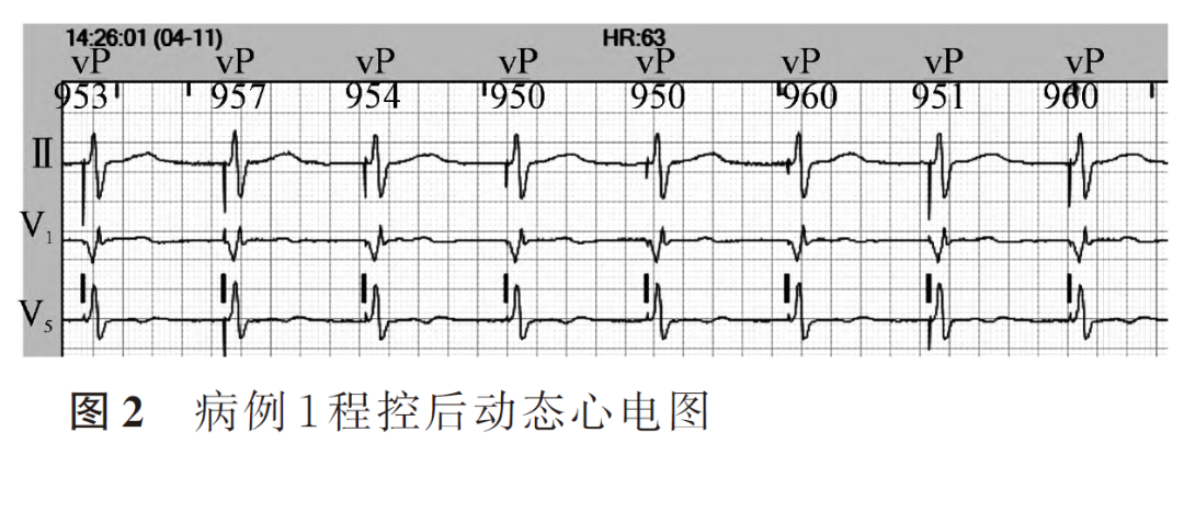 百多力起搏器怎么样两种心室起搏图形的3 种情况_https://www.jmylbn.com_新闻资讯_第4张