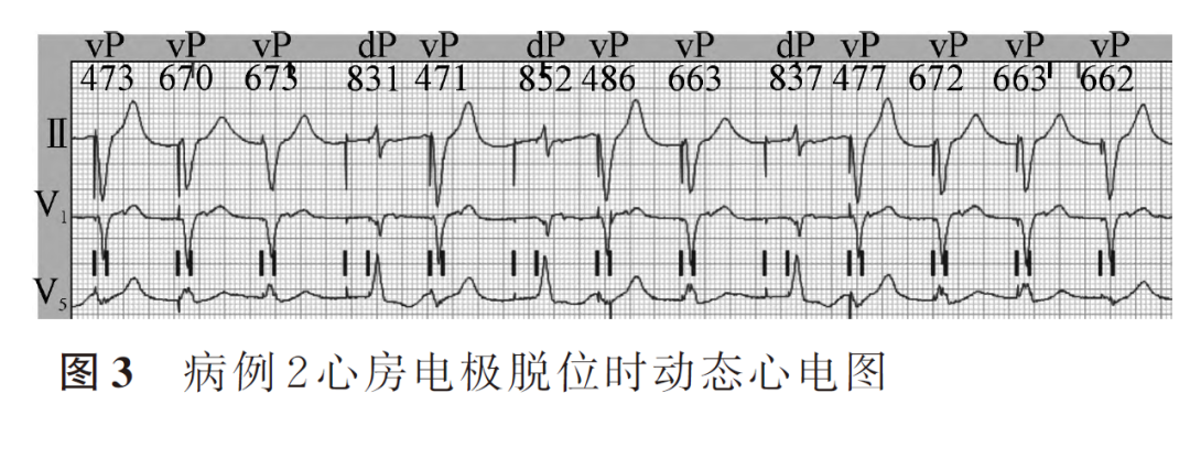百多力起搏器怎么样两种心室起搏图形的3 种情况_https://www.jmylbn.com_新闻资讯_第5张